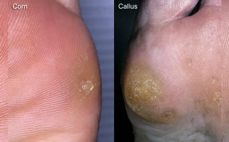 What are Corns and Calluses