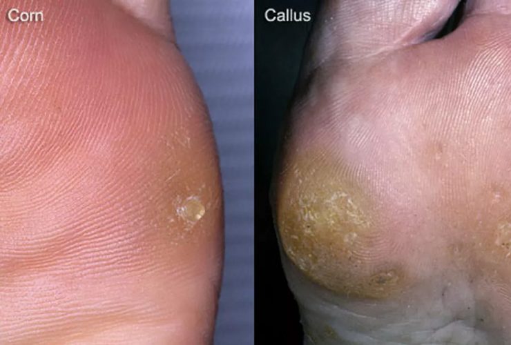 What are Corns and Calluses