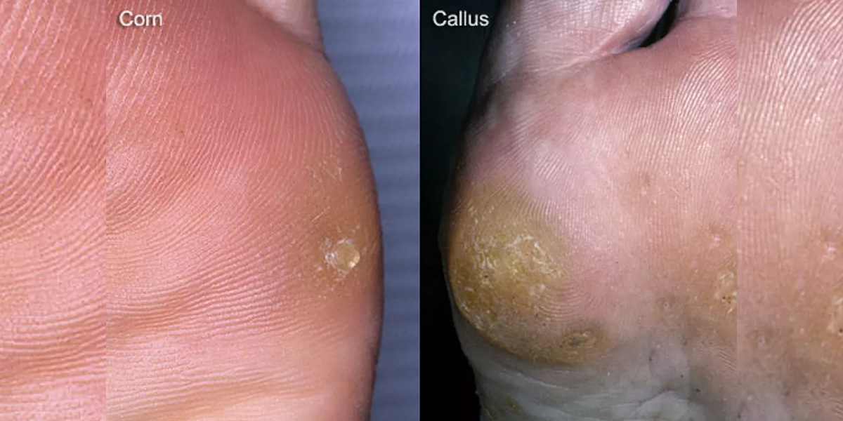 What are Corns and Calluses