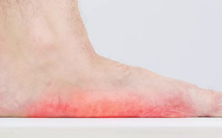 What are flat feet