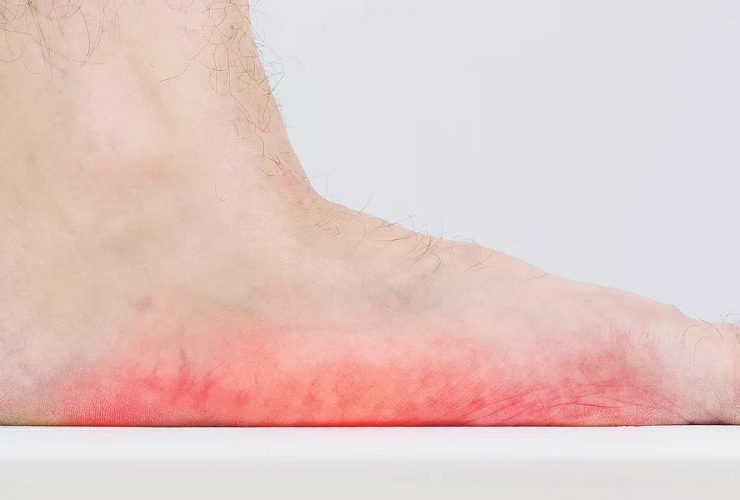 What are flat feet