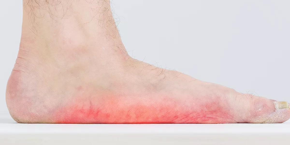 What are flat feet