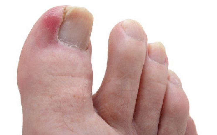 What are ingrown toenails