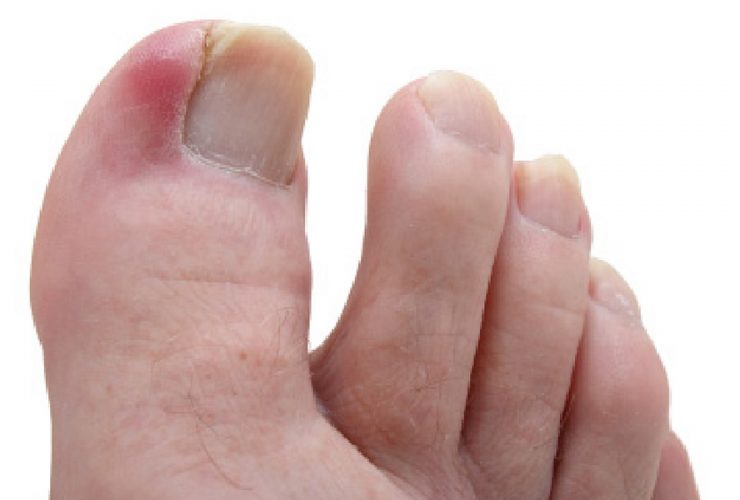 What are ingrown toenails