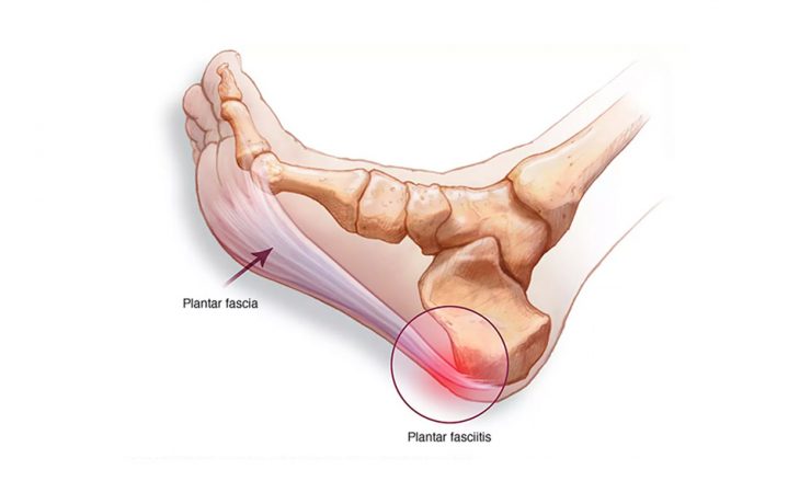 What is plantar fasciitis