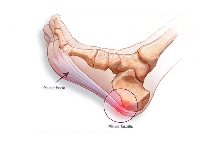 What is plantar fasciitis