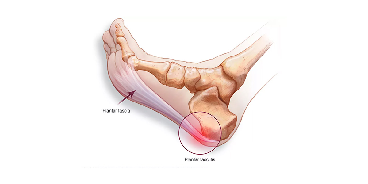 What is plantar fasciitis